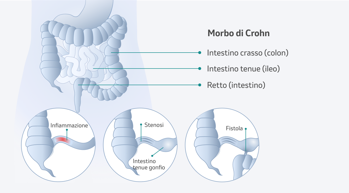 Morbo Di Crohn - Definizione | MSD Salute Svizzera